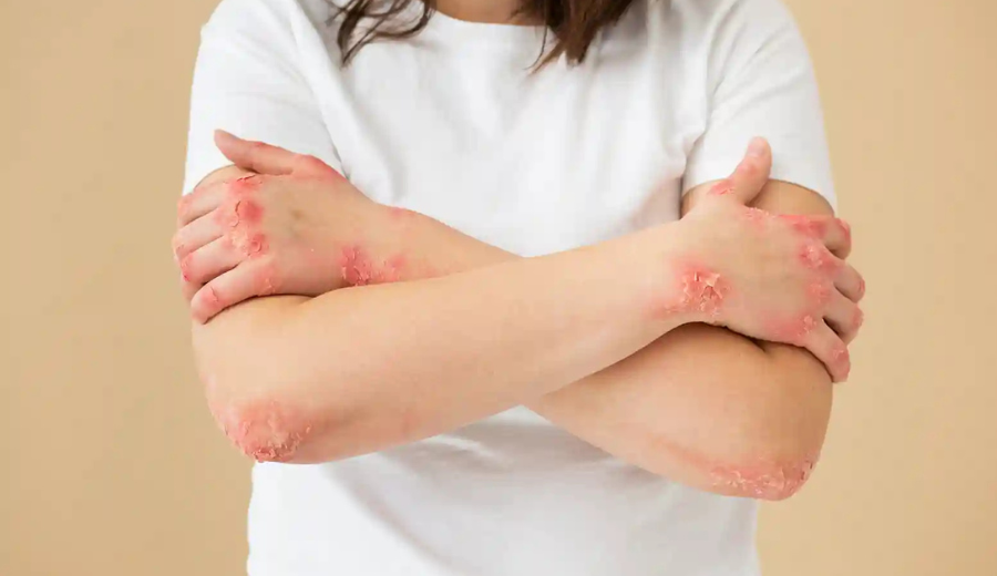 How to Get Rid of Scabies